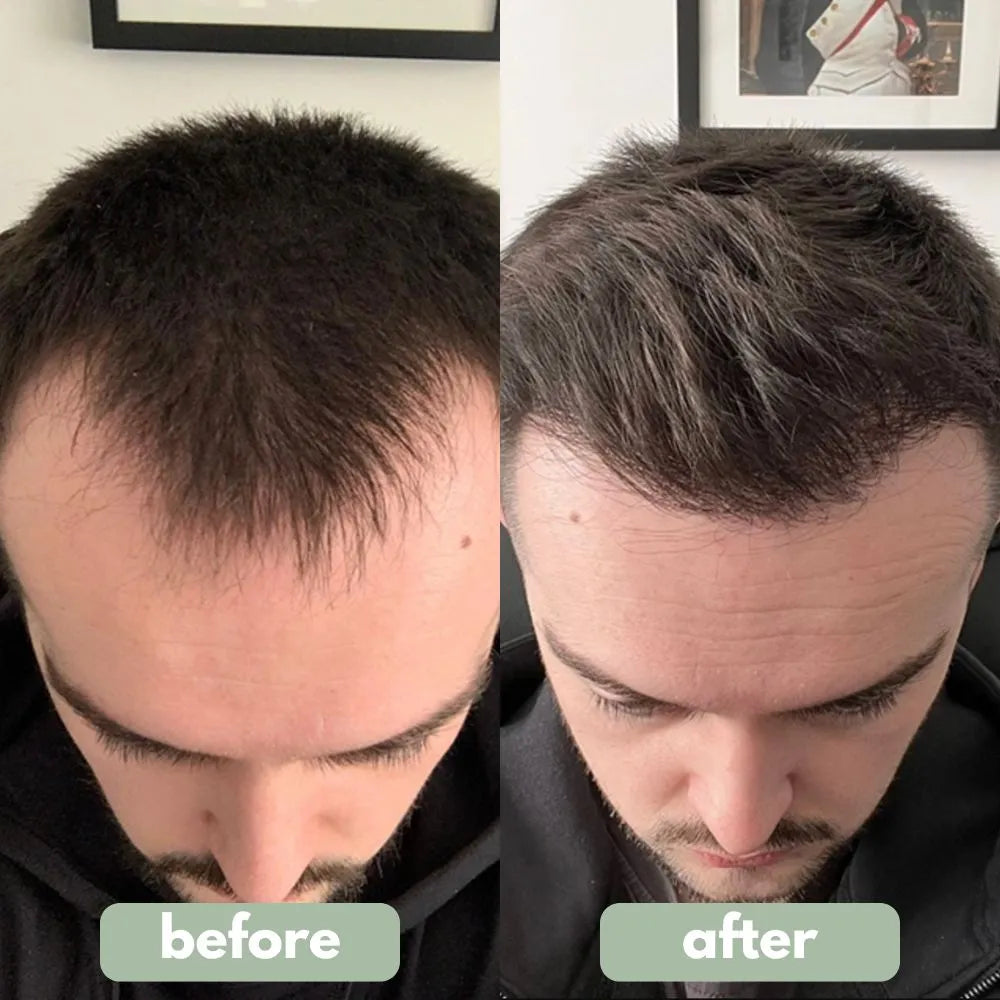BodyWise™ Advanced Hair Growth System
