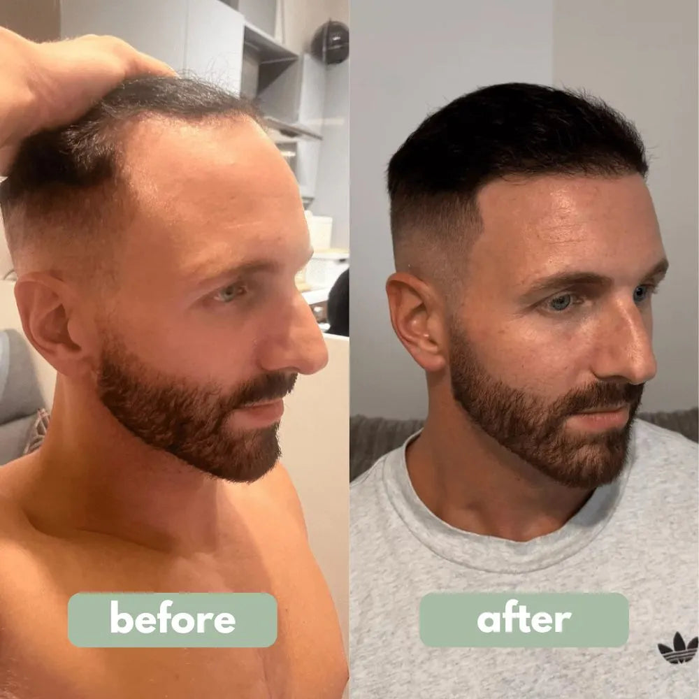 BodyWise™ Advanced Hair Growth System